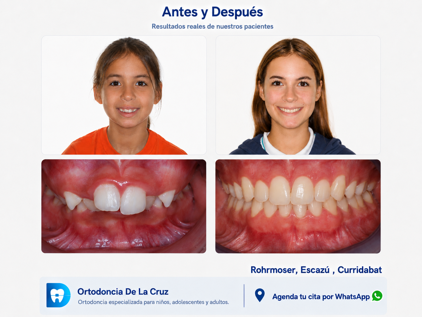 Niña antes y luego de adolescente despues de ortodoncia de dos fases