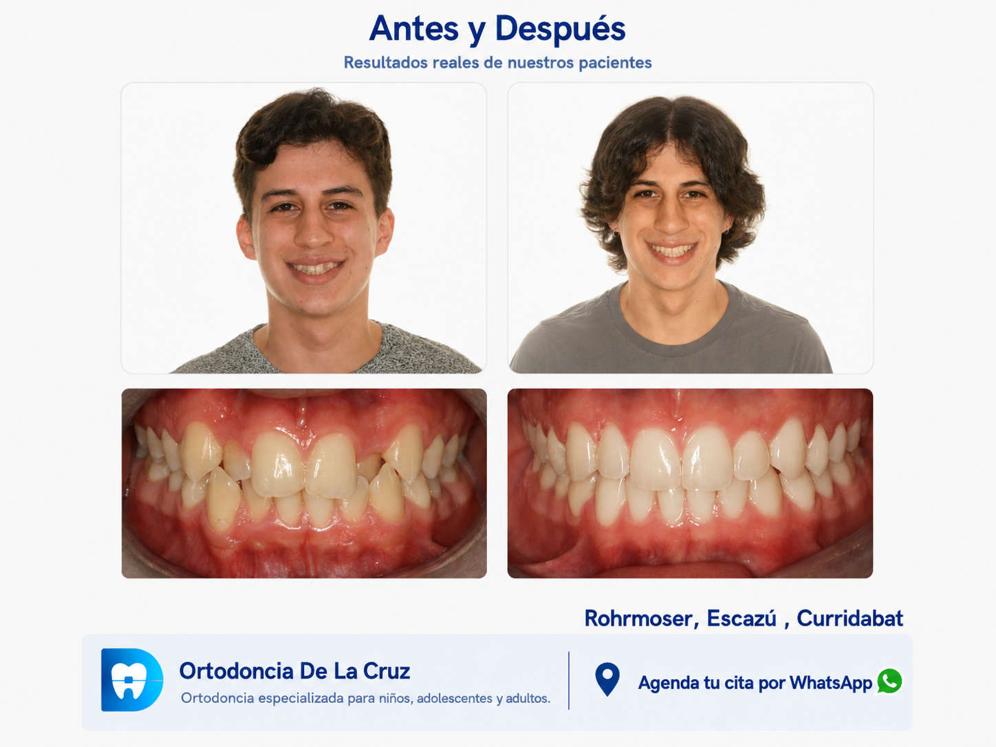 Paciente tratado con alineadores Invisalign