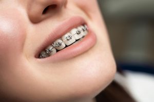 Paciente con brackets metálicos tradicionales para corregir la posición de los dientes.