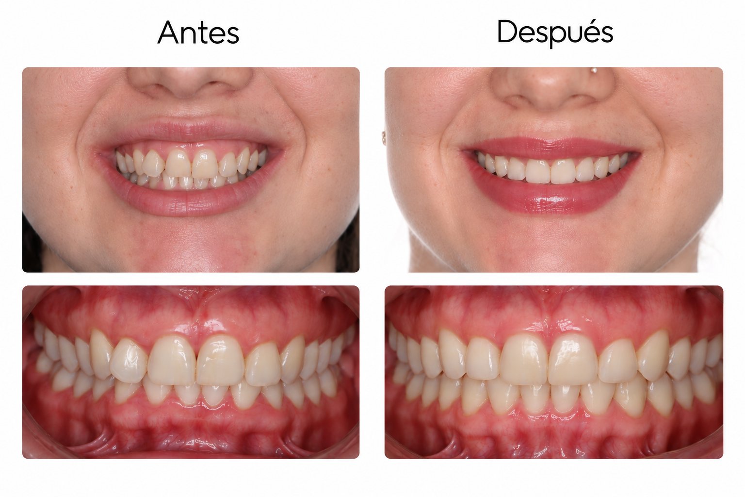 Antes y después de tratamiento con Invisalign en Costa Rica
