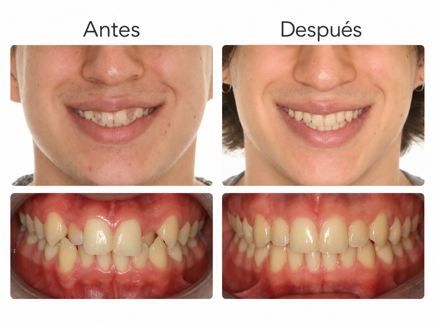 Antes y después de tratamiento con alineadores Invisalign en Costa Rica